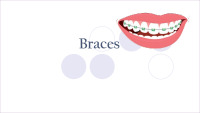 Slides about Braces 1