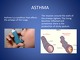 Asthma And DM slides