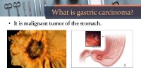 Gastric carcinoma 3