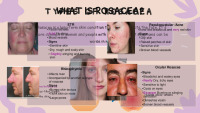 Slides on Rosacea disease 2