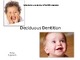 Deciduous dentition